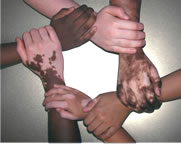 support-leucoderma-patient