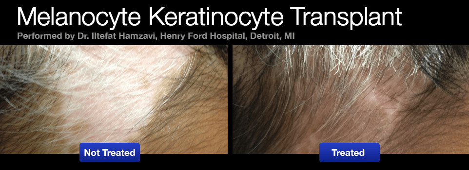vitiligo-melanocyte-keratinocyte-transplant